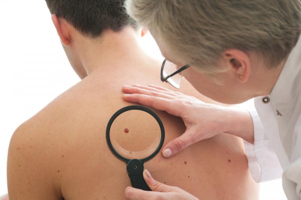Британские онкологи назвали самый верный симптом рака кожи